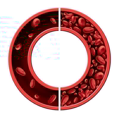 46-2 Hemolytic Anemia.jpg