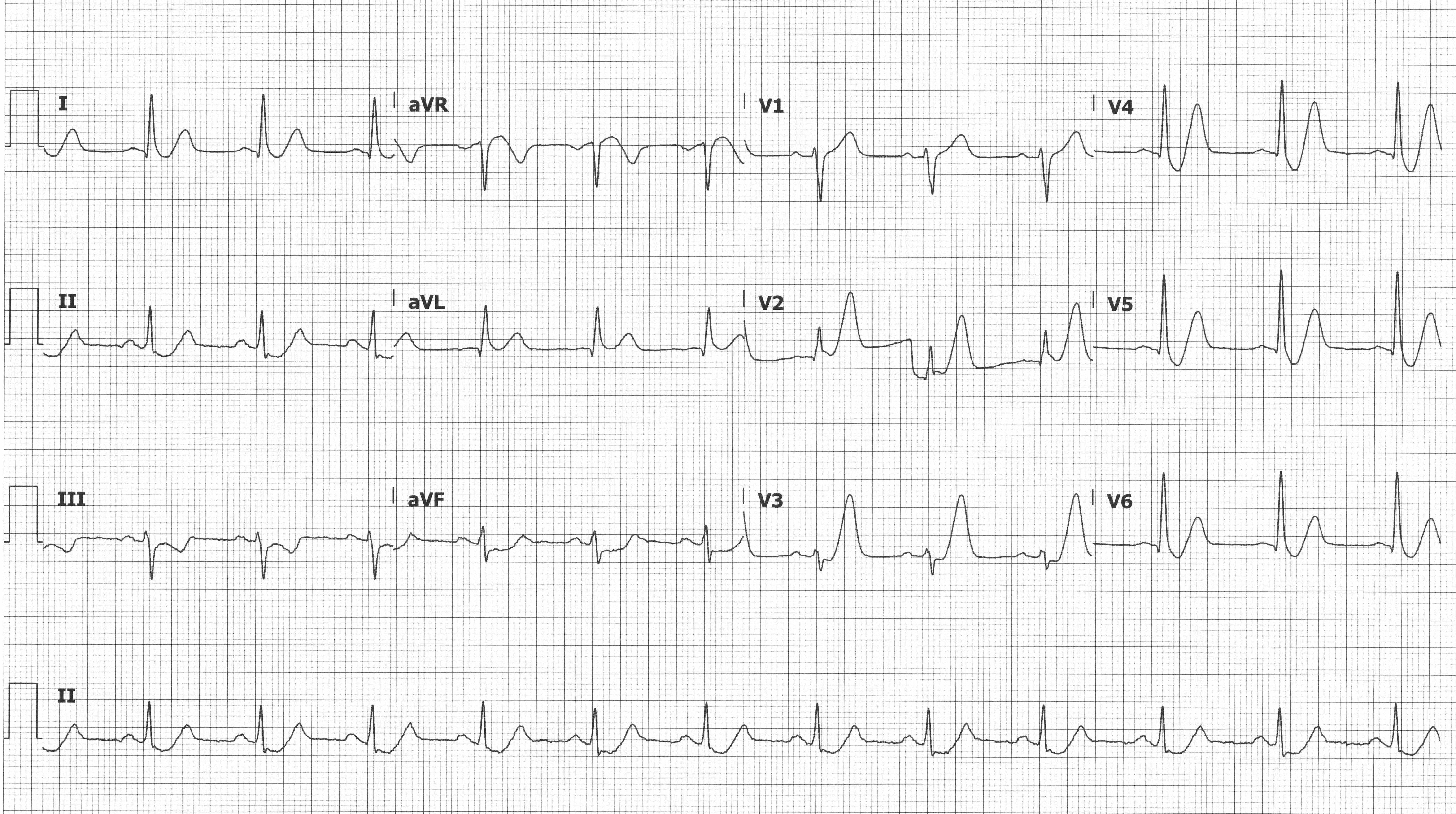 ECG showing 0.5-1 mm ST segment elevation in lead III, TWI in leads III