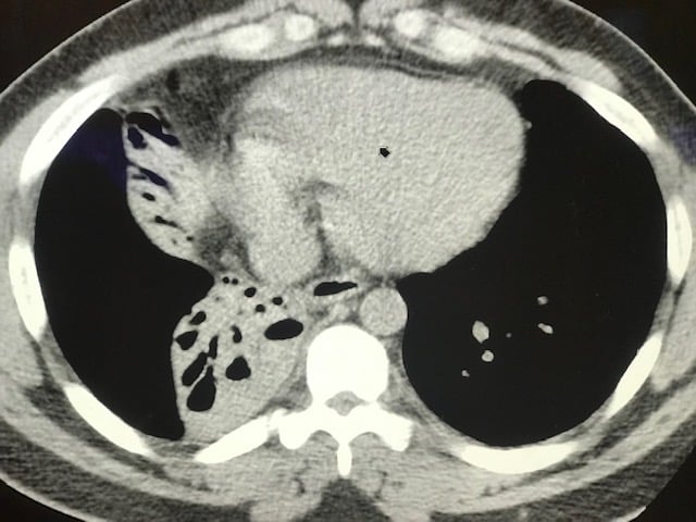 Case Report - Foreign Body - Scan 1.jpg