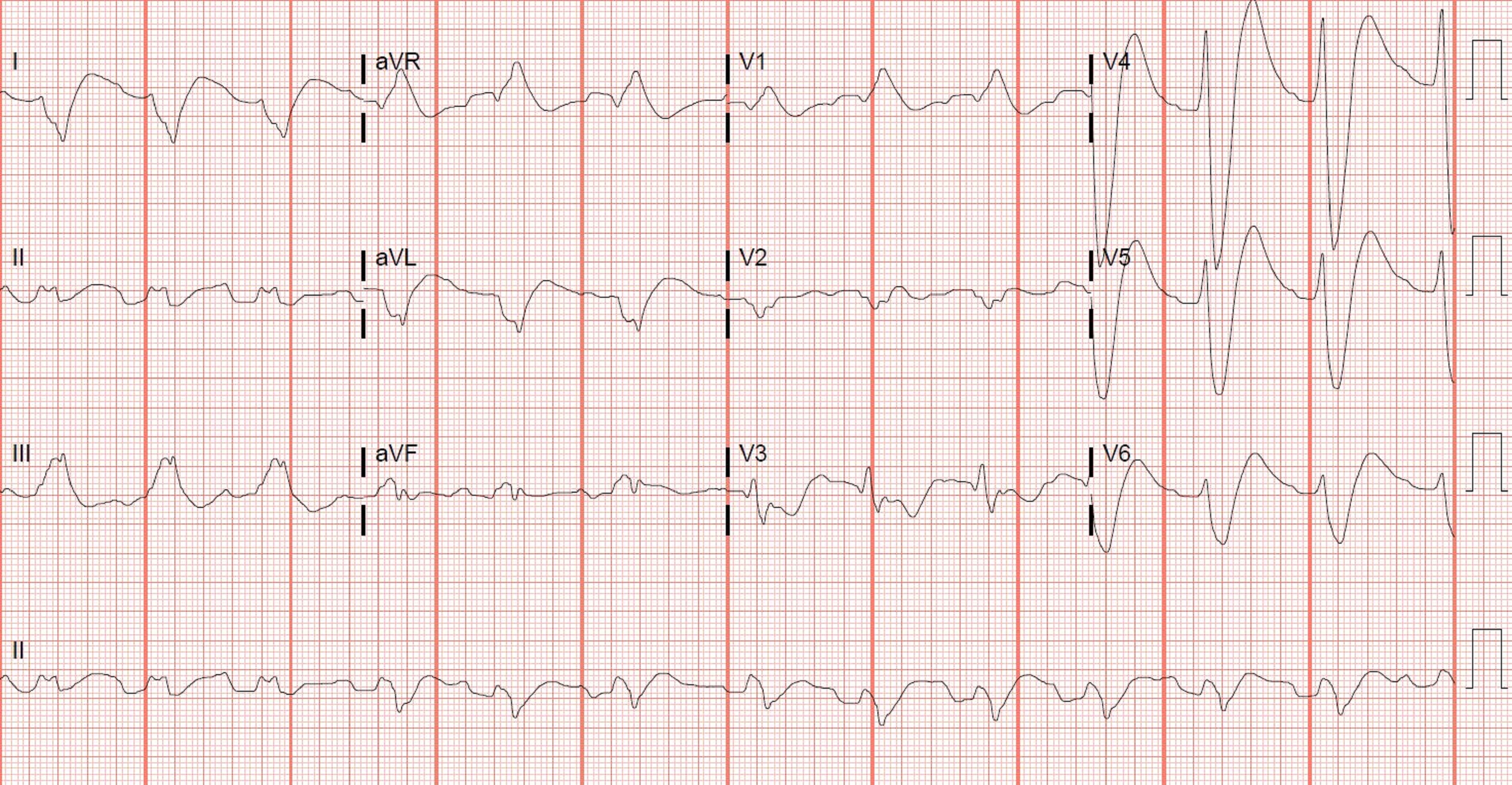 Toxicology - Flecainide OD - ecg.JPG