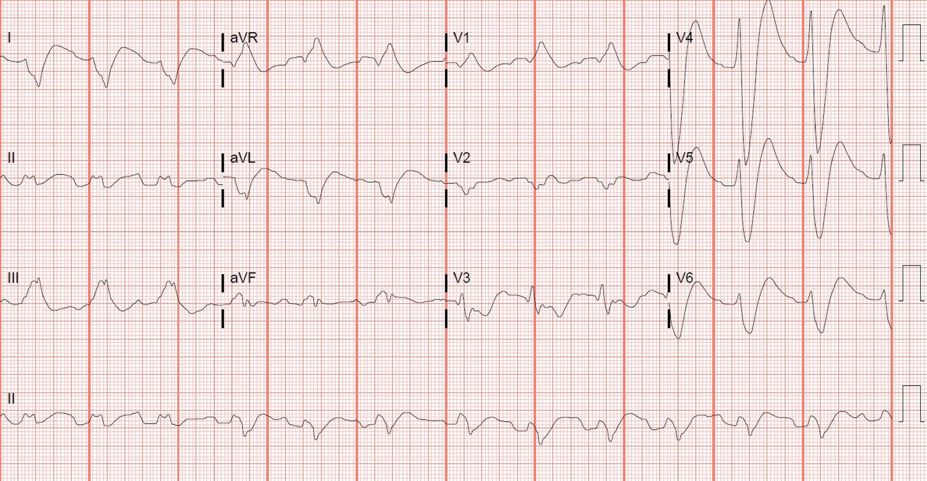 Toxicology - Flecainide OD - ecg.JPG