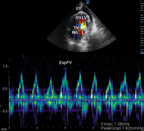 Ultrasound - Cardiac Tamponade - Image 3a.png