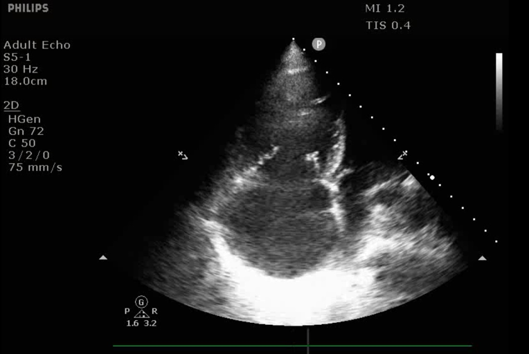 Figure 2. A4 view with RV enlargement