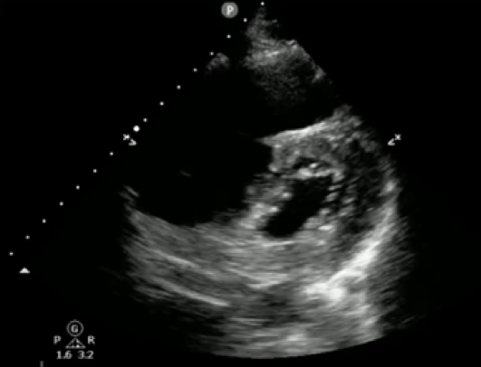 Figure 3. Parasternal short axis view