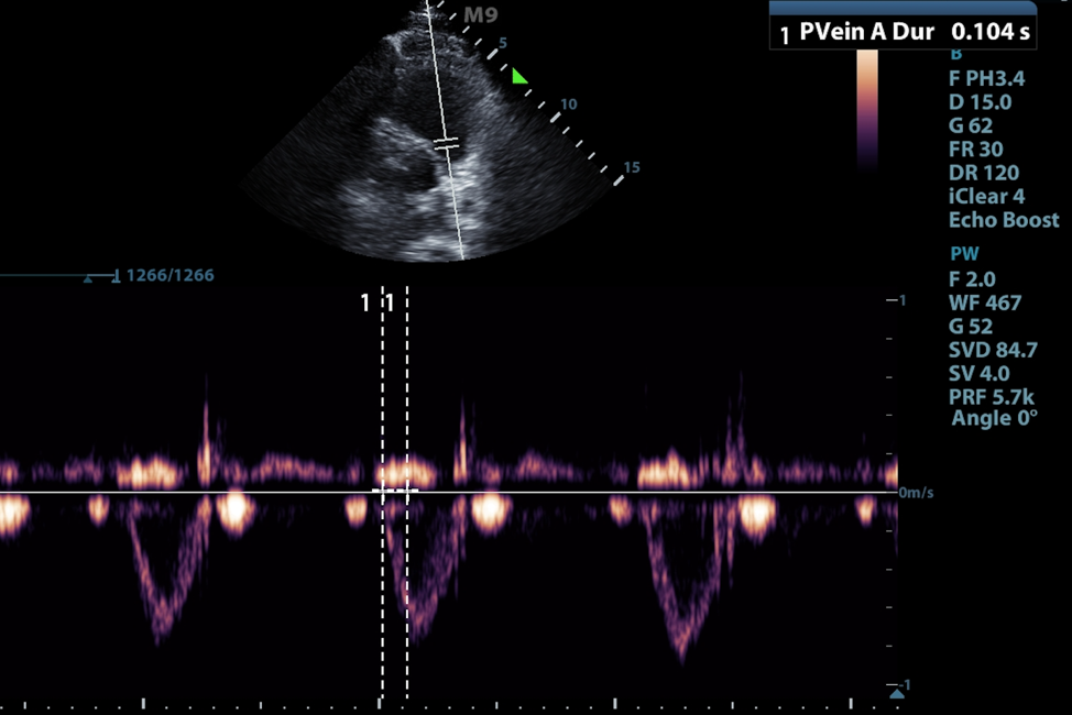 Figure 6. Pulmonary acceleration time