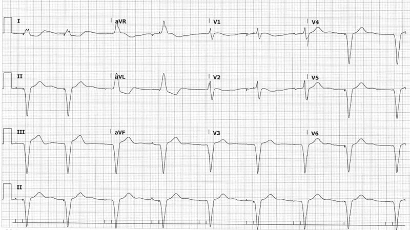 Initial ECG