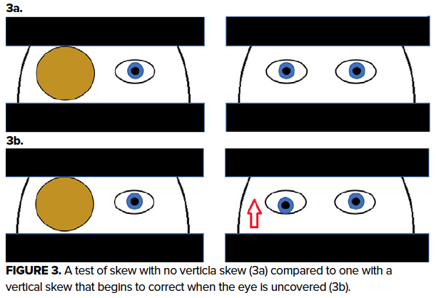 Direction-changing nystagmus