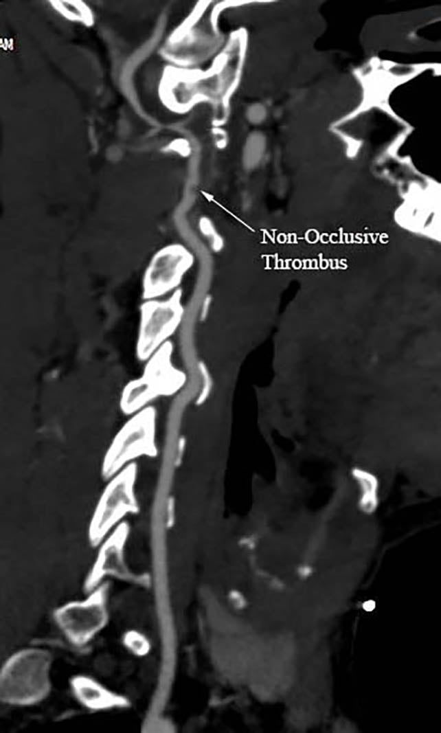 CT angiogram of the neck