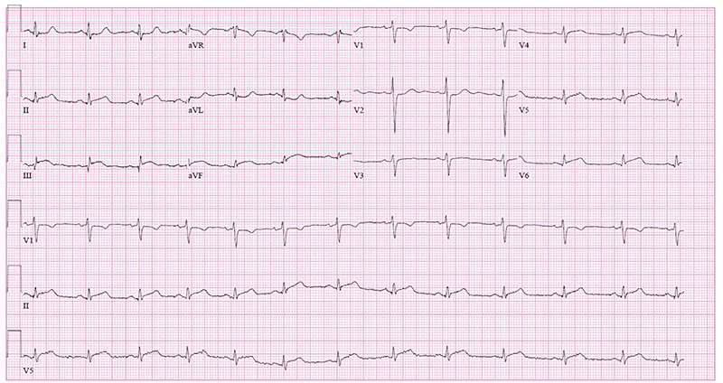 Figure 1 Initial EKG