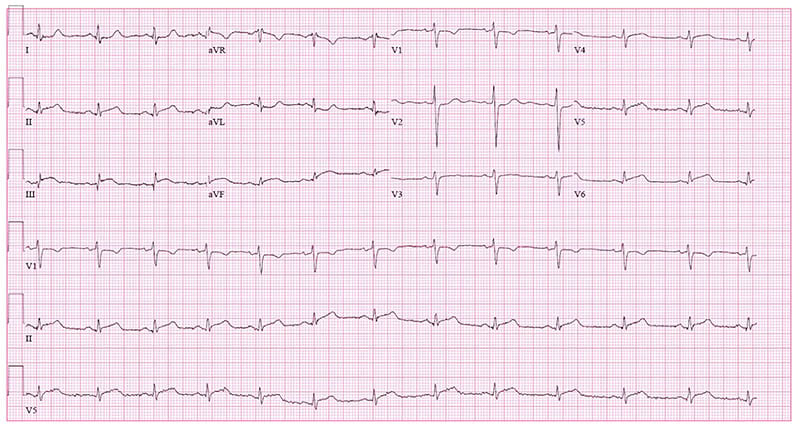 Figure 1 Initial EKG