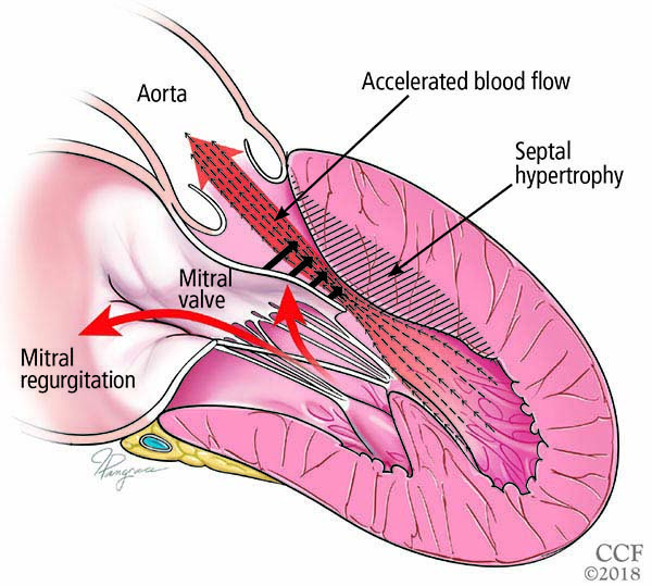 46-5 AFib in HCM - CCJMYoungFig3.jpg