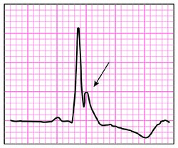 46-5 ECG Challenge - J-wave illustration.jpg