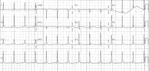 46-5 ECG Challenge - osborn waves.jpg