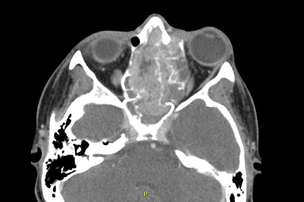 47-1 Nasopharyngeal Tumor - CT Head_web.jpg