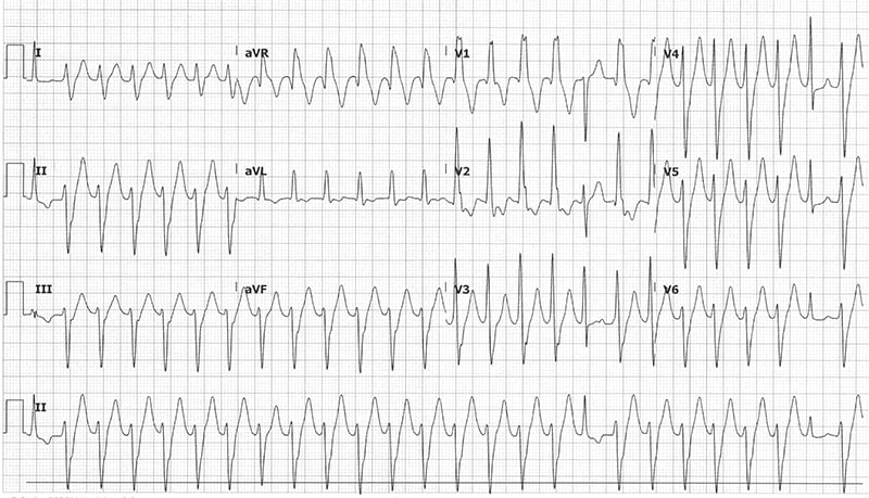 47-2 ECG Challenge - Post fasc VT.jpg