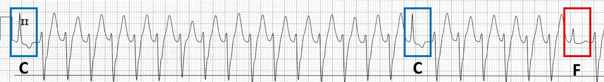 47-2 ECG Challenge Answer Figure.jpg