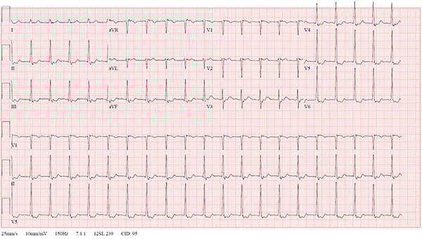 47-2 NSVT After REVERT figure-1-initial-ekg_web.jpg