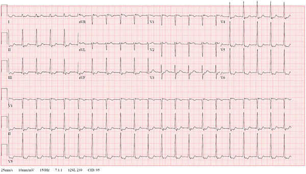 47-2 NSVT After REVERT figure-1-initial-ekg_web.jpg