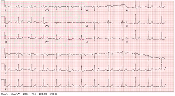 47-2 NSVT After REVERT figure-3-post-ekg_web.jpg
