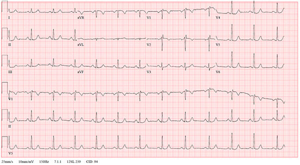 47-2 NSVT After REVERT figure-3-post-ekg_web.jpg