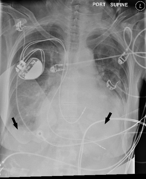 47-2 Old Cold Trauma - CXR_web.jpg