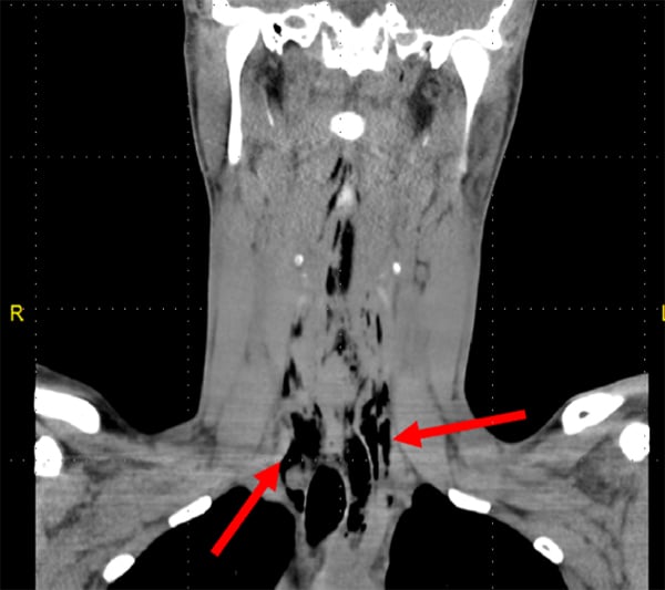 47-2 Pneumomediastinum Figure 1_web.jpg