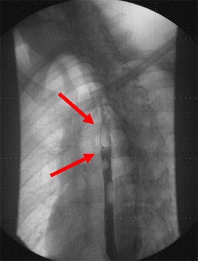 47-2 Pneumomediastinum Figure 3_web.jpg