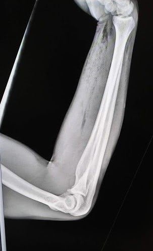 47-2 Water Pressure Injury - xray-lateral-view_web.jpg