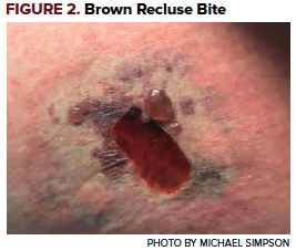 47-3 Brown Recluse - Figure 2.png