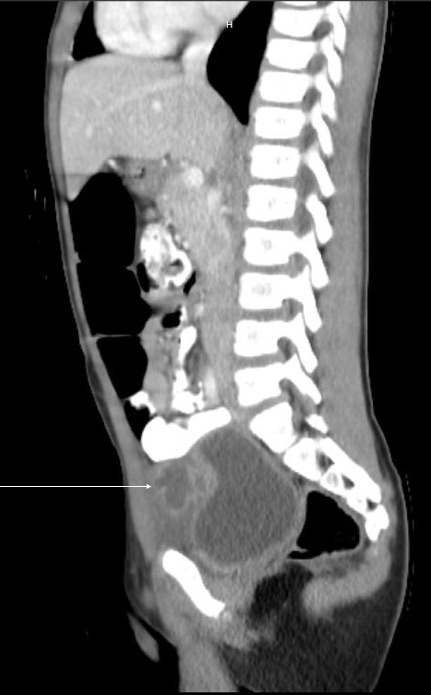 47-4- Dysuria__Urachal Cyst_6-12-20_Figure 2.jpg