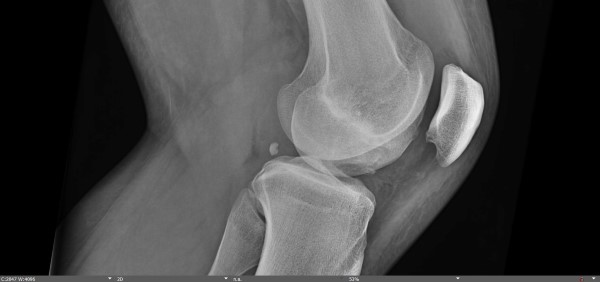 47-4 Joint Pain - Figure 2 - xray.jpg