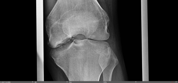 47-4 Joint Pain - Figure 3 xray.jpg