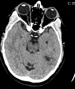 47-4 Preeclampsia Figure 1.png