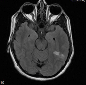 47-4 Preeclampsia Figure 2.png