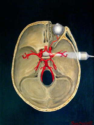 Transcranial Doppler - Figure 1B.jpg