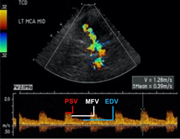 Transcranial Doppler - figure 3.jpg