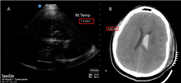 Transcranial Doppler - figure 4.jpg