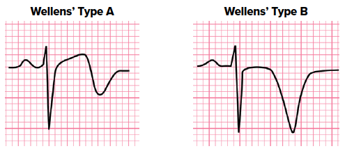 47-5 ECG Challenge Wellens.png