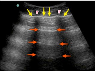 Lung POCUS - Figure 2.jpg