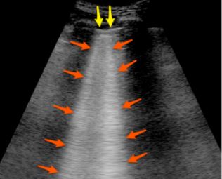 Lung POCUS - Figure 3.jpg