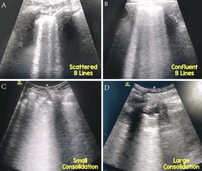 Lung POCUS - Figure 5.jpg