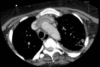 Septic Thrombophlebitis - Image 2.png