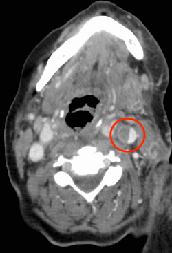 Septic Thrombophlebitis - Image 3.png