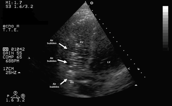 Venous Air Embolim - Figure-1-air-in-rv.png