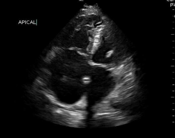 Venous Air Embolism - Figure-2-rv-dilation.png