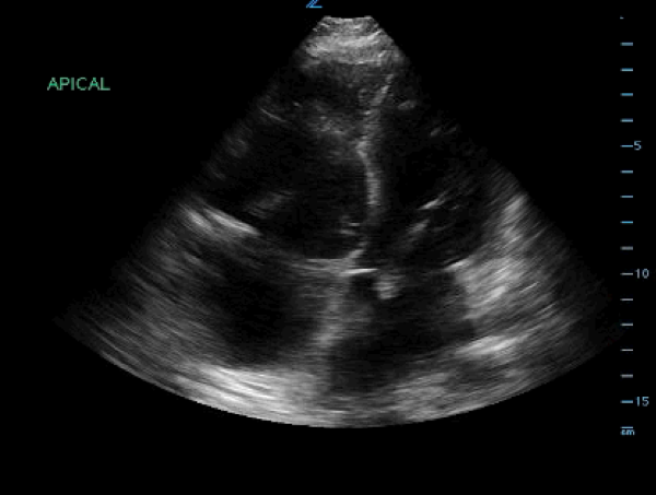 Venous Air Embolism - Figure-3-d-sign.png