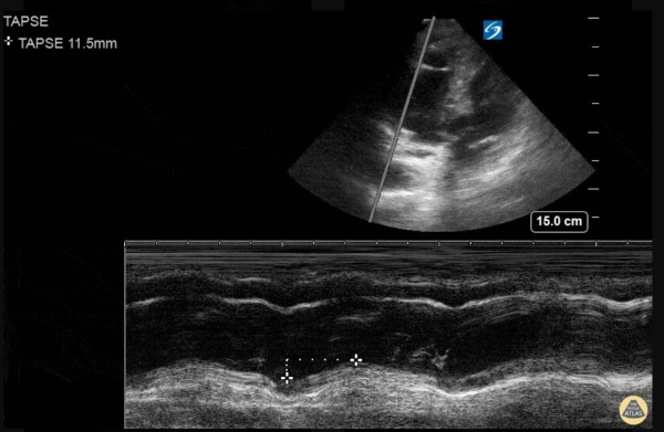 Venous Air Embolism - Figure-4-tapse.png