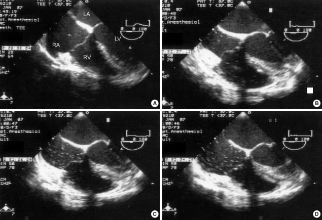 Venous-air-embolism-detected-by-transesophageal-echocardiography-mid-esophageal.png