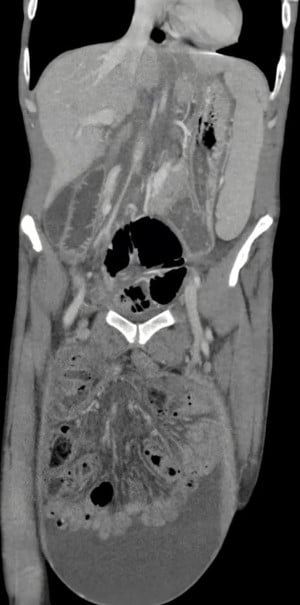 Scrotal Hernia - CT.jpg