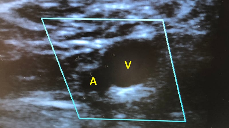 47-6 Popliteal Artery - anchor.jpg